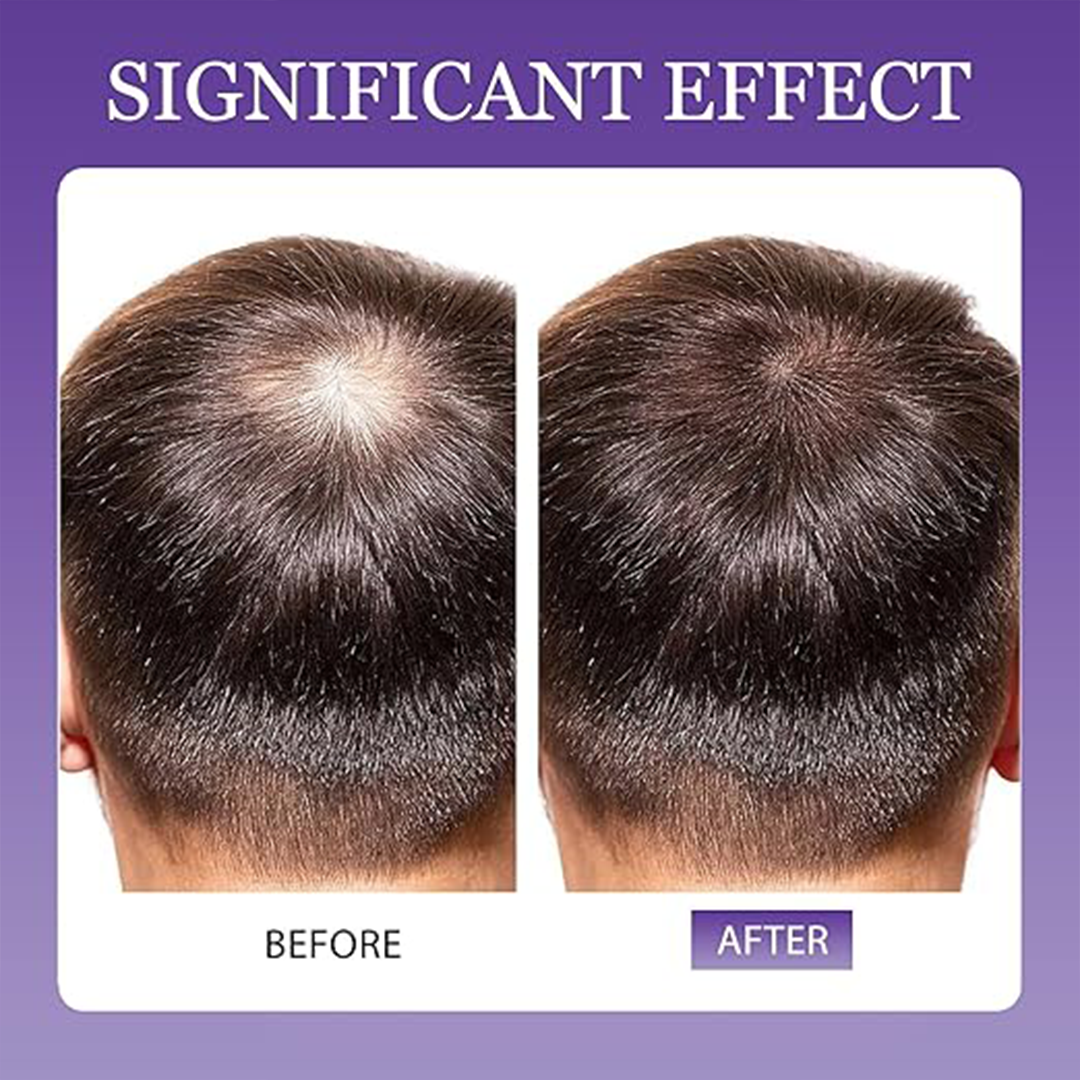 5% Minoxidil Hair Growth Spray for Men and Women 2 x 30ml Hair and Beard Regrowth Treatment for Thinning Hair