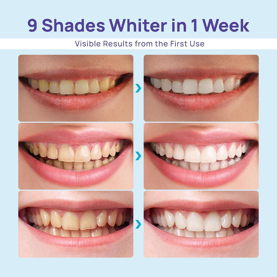 Whitebite Pro طقم تبييض الأسنان – للأسنان الحساسة