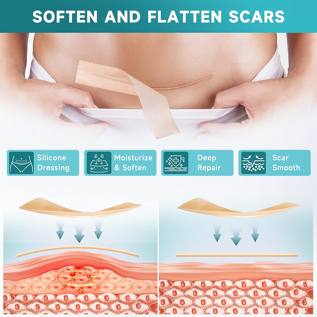 Medical Grade Silicone Scar Tape Roll 4 cm x 3 m Reusable Waterproof Scar Sheets for Surgical C Section Burn and Keloid Scars