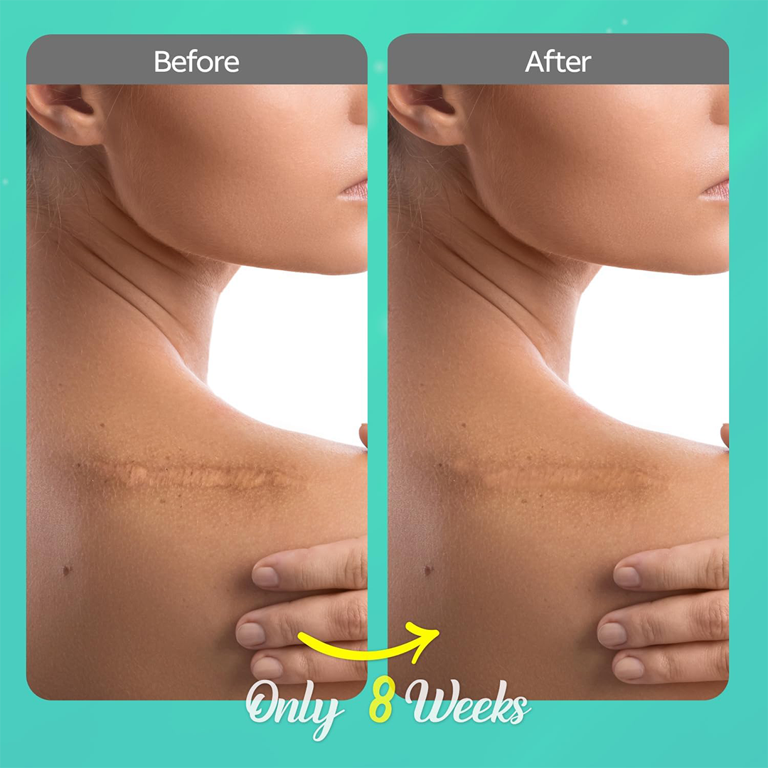 Scar Care Silicone Scar Gel Scar Removal Cream for Old & New Scars