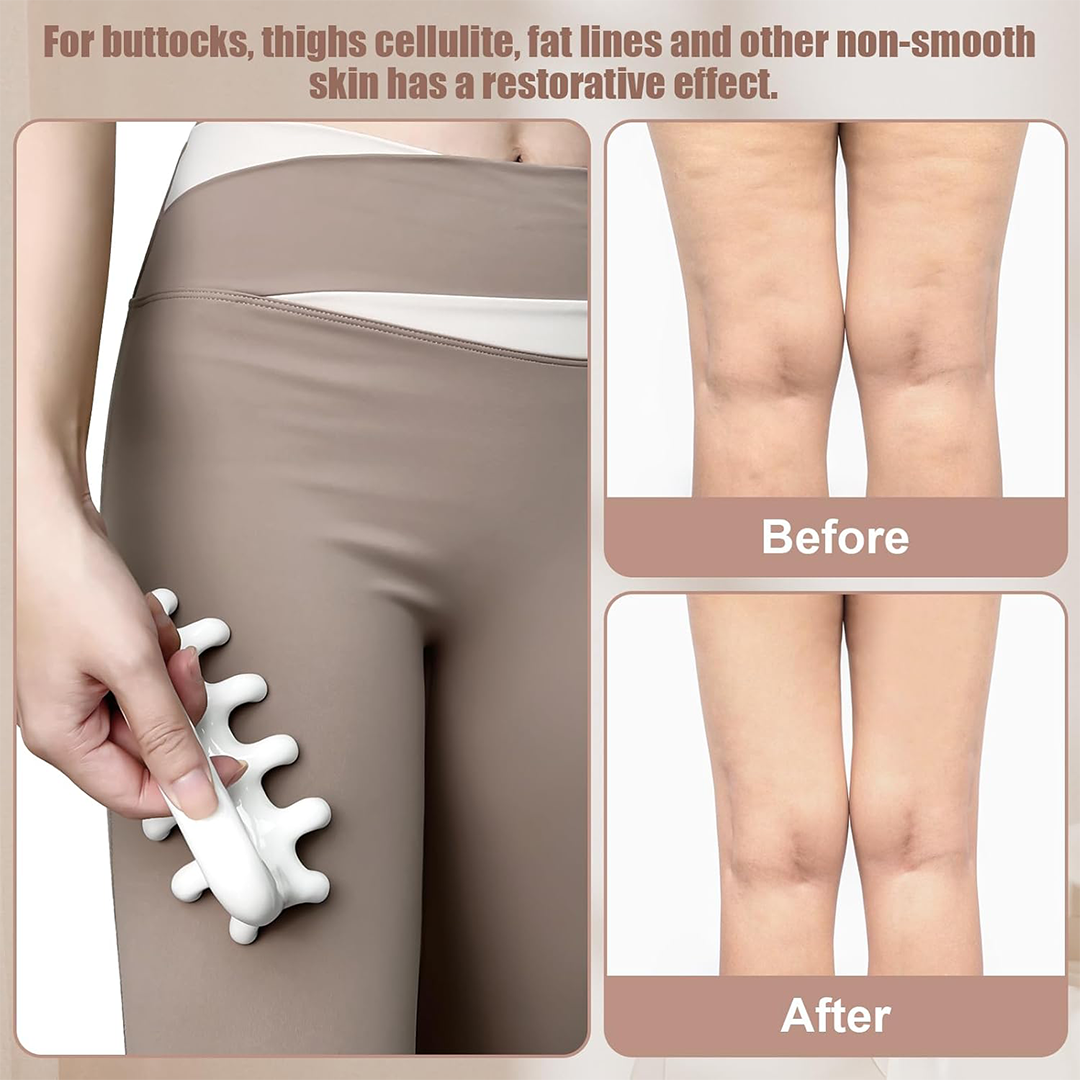 Vemoky Fascia Massage Tool – Deep Tissue Trigger Point & Anti-Cellulite Massage Tool