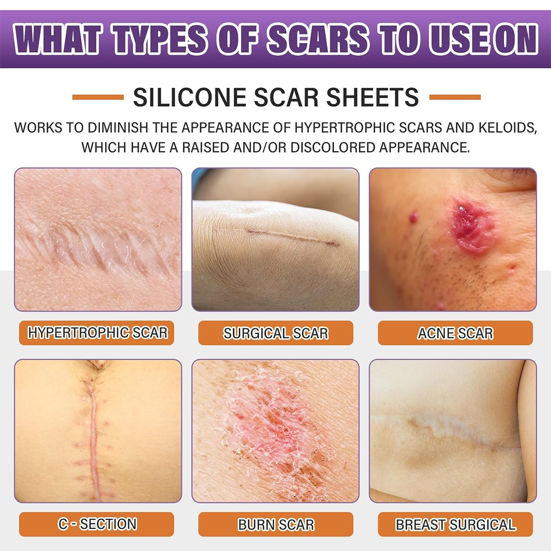 Psecici Silicone Scar Tape for Surgical Scars,Extra Long Scar Sheets for C-Section, Tummy Tuck